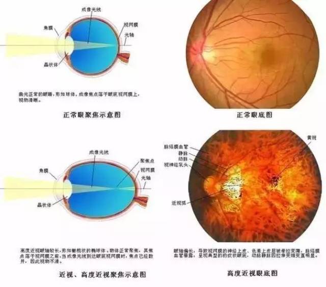 高度近视眼底病变可能会引起以下并发症: ★ 后巩膜葡萄肿:发生率为