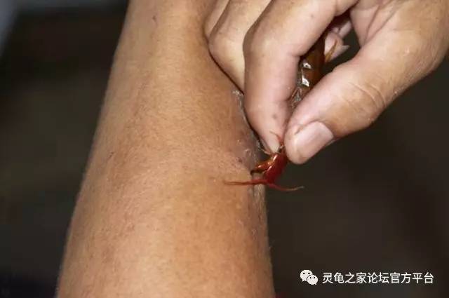一般被蜈蚣咬后,会发现咬伤区域有两处肿胀且发红的穿刺伤口,伤口
