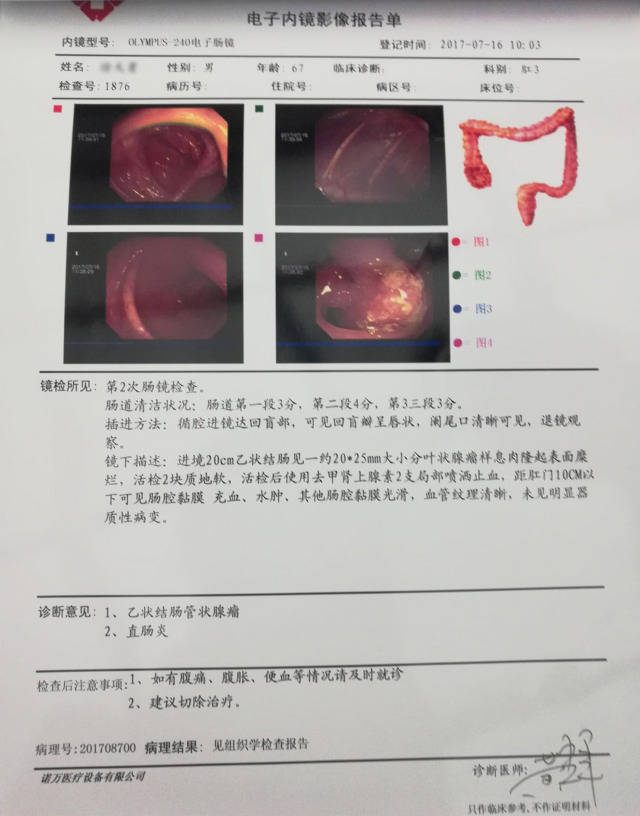 重庆东大肛肠医院帮助肠道肿瘤患者摆脱折磨