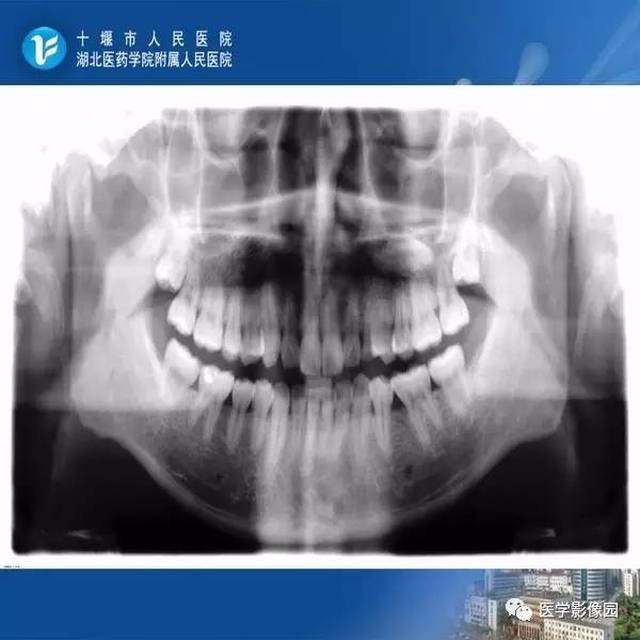 口腔颌面医学影像诊断学(颌面骨炎症)| 影像天地