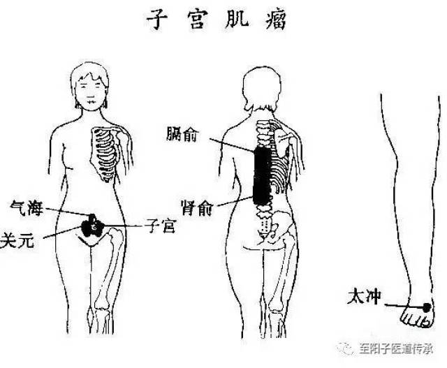 则在肩胛与臂的骨缝中刮出痛点或挤包,其痛即减!