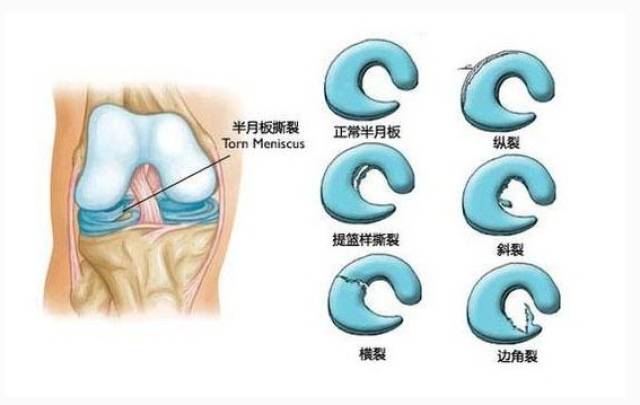 半月板损伤腿就废了吗,6个问题帮你认知