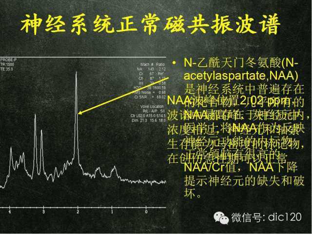 《基础知识》脑磁共振波谱mrs的重要诊断价值—附精彩病例解析