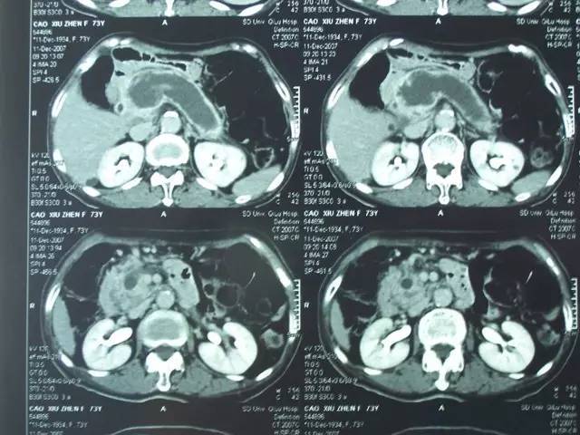 快速掌握胰腺占位性病变 ct 读片技能