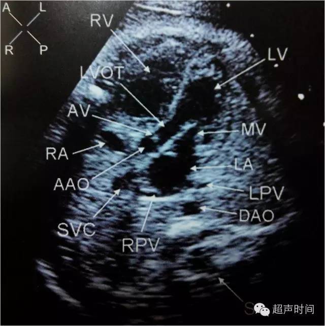 【超声微课堂】胎儿心脏超声常用切面