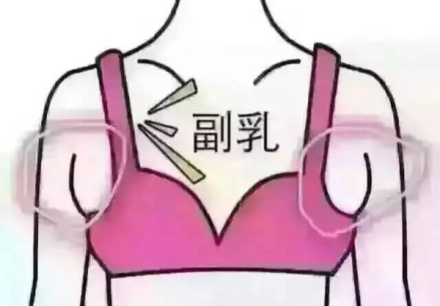 副乳增大