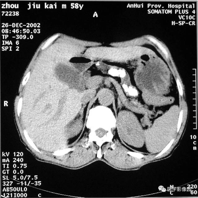 图6-4-7慢性胰腺炎 ct平扫胰腺弥漫性萎缩, 主胰管明显扩张(↑), 胰管