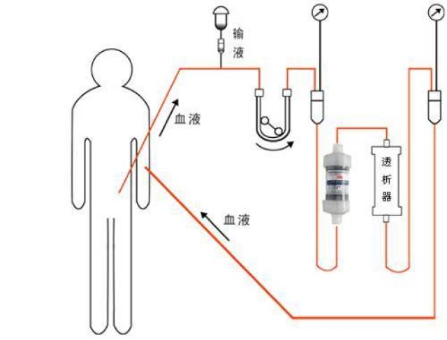 我们完全有理由相信,比腹膜透析,血液透析,更舒适,更符合人体生理的