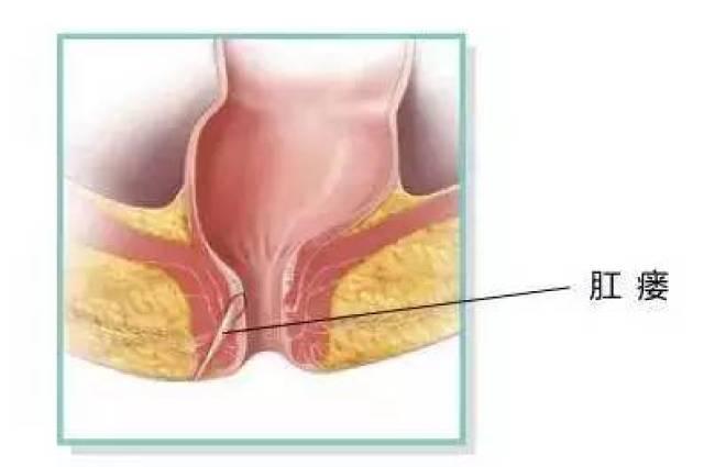 肛瘘占人口总数_肛瘘手术图片