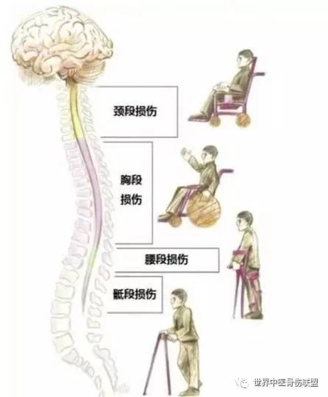 脊柱损伤的康复治疗