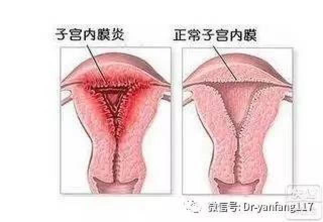 萎缩性子宫内膜炎最容易导致绝经后异常出血,是在绝经后萎缩的子宫