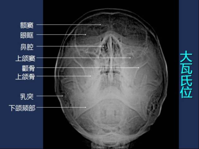 【收藏】全身x线图谱,阅片必备 !