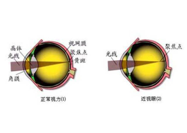 家有"近视娃"必看,恢复视力不发愁