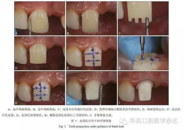 一种显微精准定深孔牙体预备技术