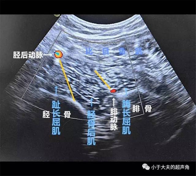 【超声解剖】你了解小腿后方深层肌群吗?