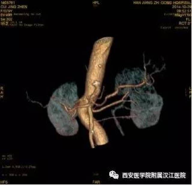 ct动脉血管成像清晰可见脾动脉近段受侵(胰腺癌)