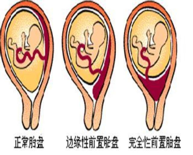 覆盖;部分性前置胎盘:宫颈内口部分为胎盘组织覆盖;边缘性前置胎盘