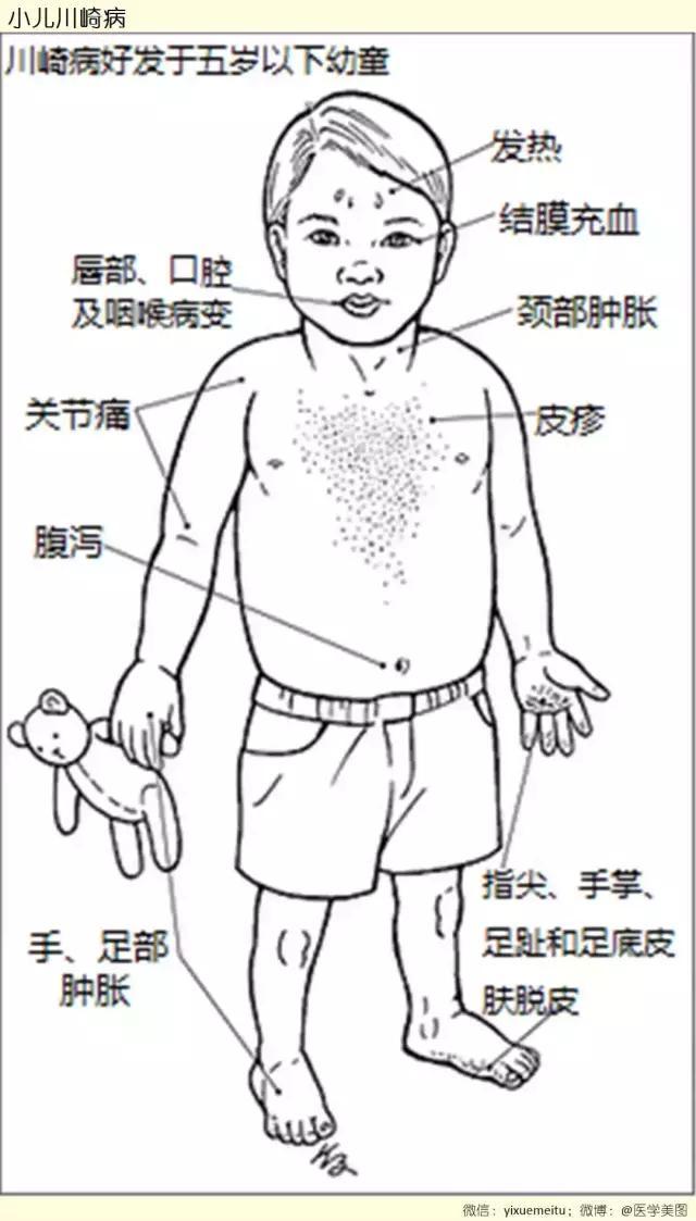 如何鉴别小儿川崎病?