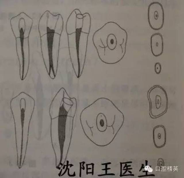 寻找根管口操作