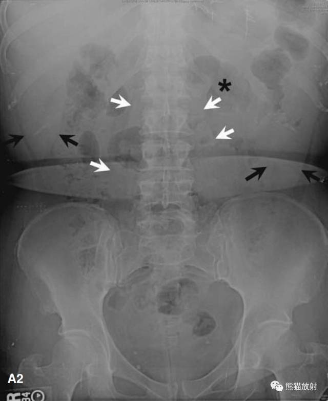 往期相关内容链接 正常卧位及立位腹部平片 normal flat plate and