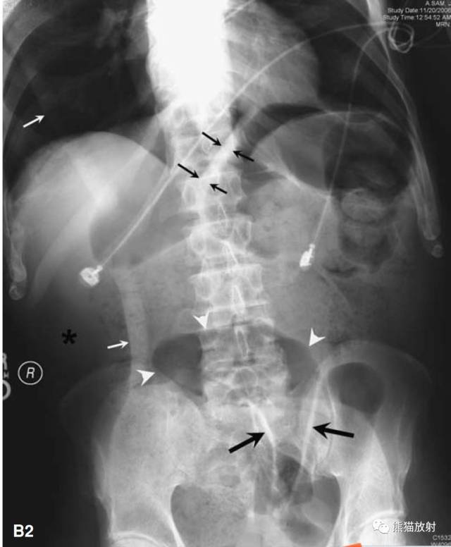 胁腹线,升结肠移位(星号) 右腹壁皮肤皱褶(白箭) 足球征(白箭头):中