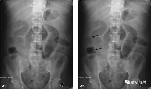 小肠积气;结肠(黑箭 腹部立位
