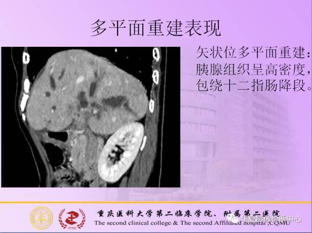 成人型环状胰腺的影像诊断!