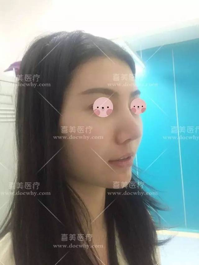 传统假体隆鼻下滑顶鼻尖修复术后1个月