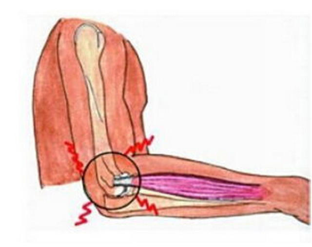 主要表现为肘关节外髁处局限性疼痛,并向前臂放射,尤其是在内旋时.