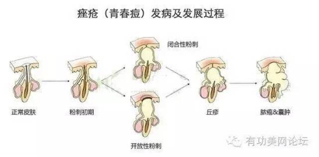 剖析痘痘的形成过程及原因!