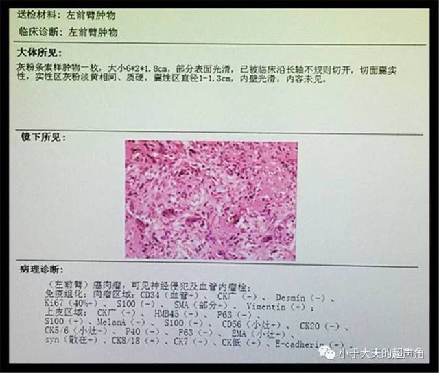 【超声】癌肉瘤 与 肉瘤样癌