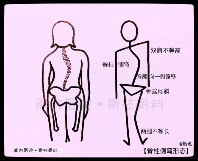 微画大健康|肩膀"一高一低"?11张漫画教你认识脊柱侧弯