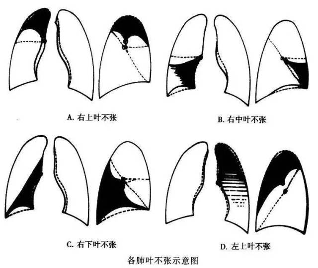 【x线诊断要点】关于"肺不张",需要弄清楚以下几点