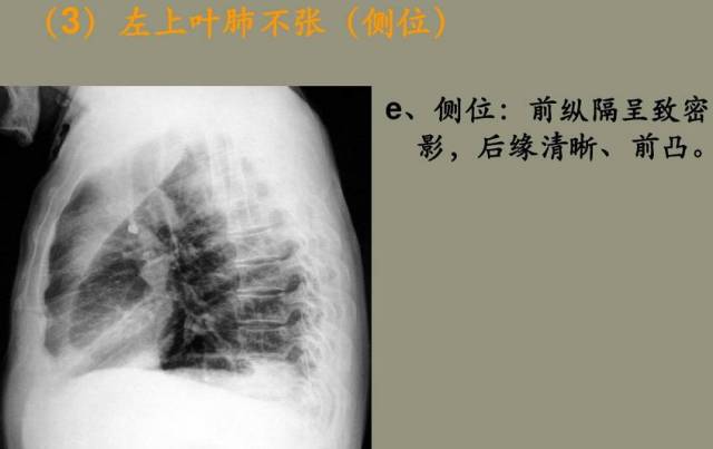 【x线诊断要点】关于"肺不张",需要弄清楚以下几点