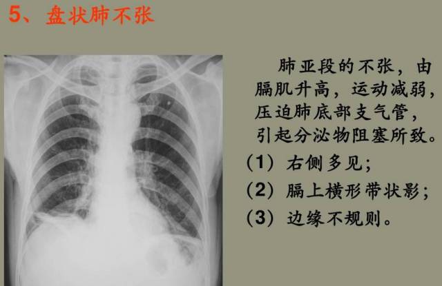 【x线诊断要点】关于"肺不张",需要弄清楚以下几点