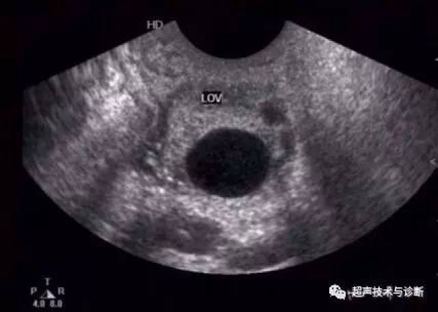 【微课堂】教你认清卵泡,排卵及黄体的超声表现