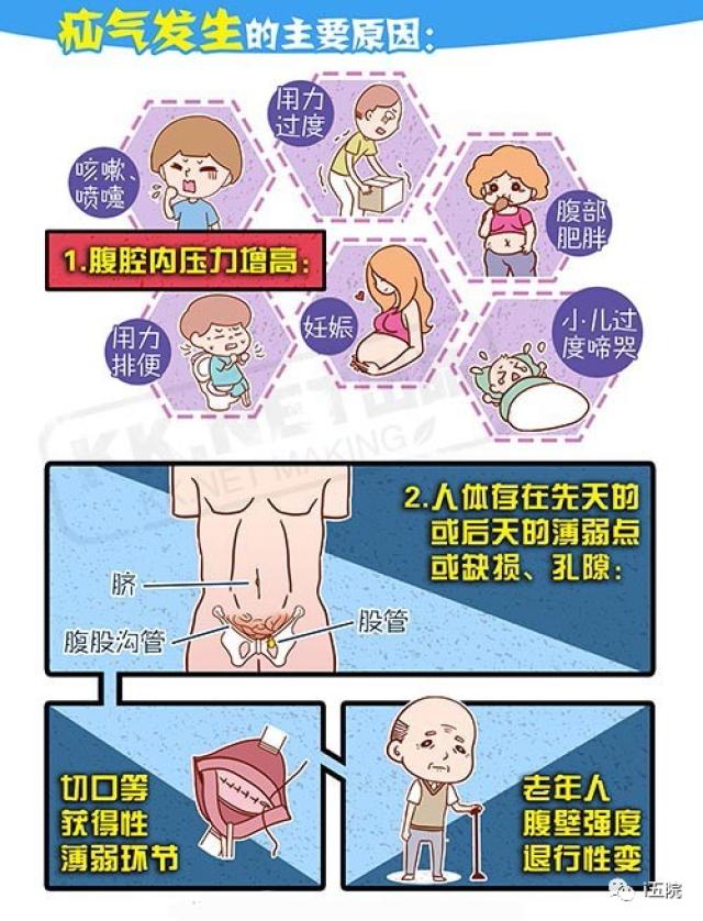 腹壁疝:小洞不补,大洞吃苦