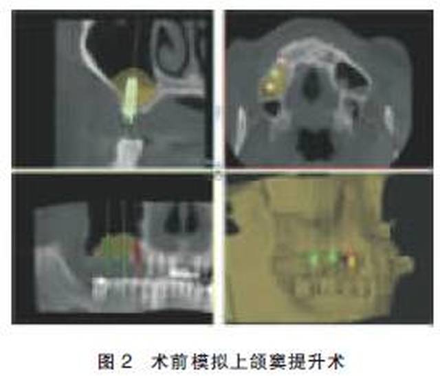 暴露颧牙槽嵴前下方上颌窦侧壁,按照术前模拟开窗位置与大小,小球钻