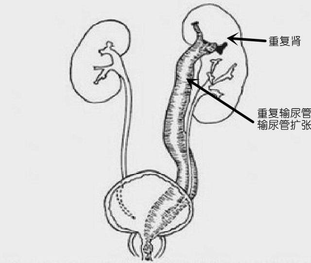 "肾小三",害人不浅阿