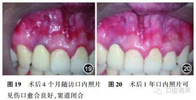 术中做龈沟瓣切口,翻瓣后见远中牙根颈部骨质缺损,肉芽组织覆盖,刮除