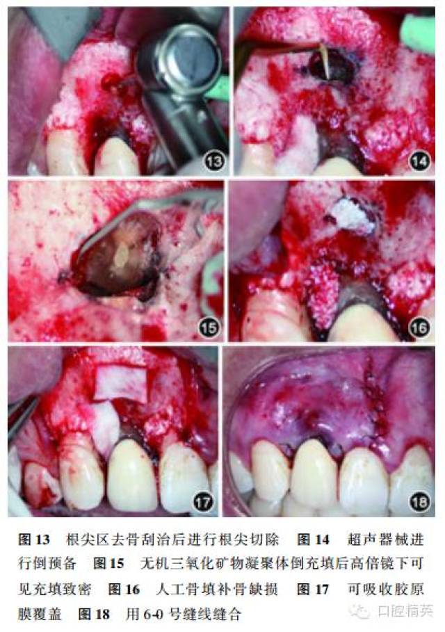 显微手术修复治疗牙根隐裂一例