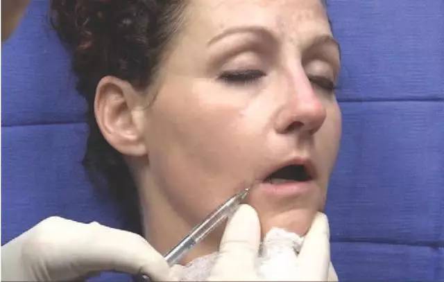 眶下孔注射避免内侧进针  上唇部 解剖要点:上唇动脉在口轮匝肌