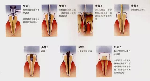 一般来讲,对于那些〖牙髓炎〗,〖牙髓坏死〗,各种类型的〖根尖周炎〗