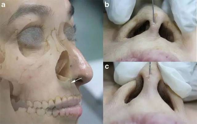 医美圈 | 泰国尸头研究:下鼻部"三脚架"式填充注射强化外鼻阀