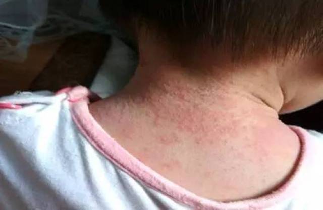 痱子·湿疹 如何区分 同样都是皮肤的炎症,但痱子和湿疹两者是有差别