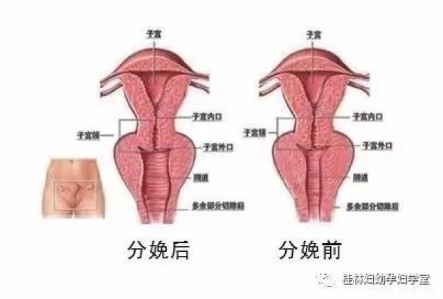 胎宝宝经产道娩出,在这个过程中,胎宝宝的身体会使阴道最大程度地扩张