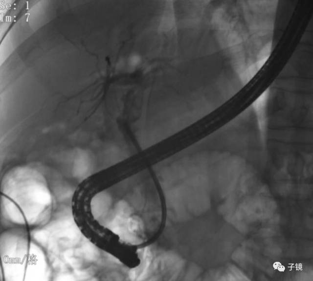 "胆管狭窄,ercp塑料支架取出困难应对策略"学习笔记