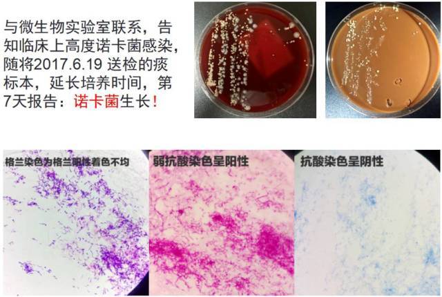 肺诺卡菌感染 2.