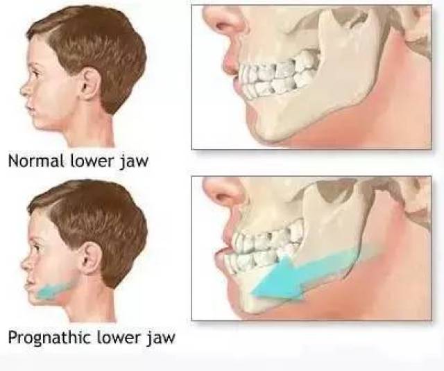 后牙反(牙合),锁(牙合):影响咀嚼功能,长期可能导致上下颌骨偏歪畸形.