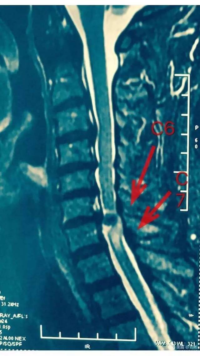 查体:双下肢感觉减退,右下肢明显,肌力肌张力正常,双侧巴氏征阴性